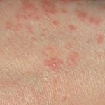 How to get rid of scabies while travelling